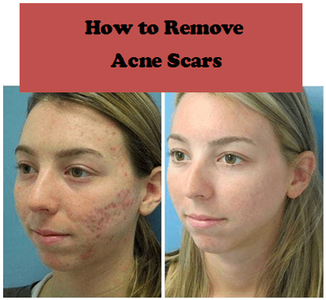 How to get rid of acne scars with light therapy, laser therapy, and skin peels that prevent breakouts and flatten skin that has raise scars or dents from zits 